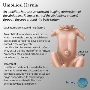 Causes and symptoms of umbilical hernia in babies