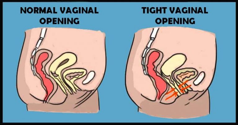 How to treat Vaginismus