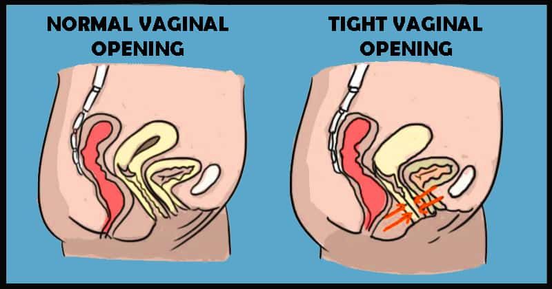 What is Vaginismus - Causes, Types and Treatment How to treat Vaginismus
