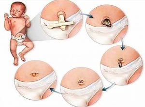 How to heal the baby's navel after birth