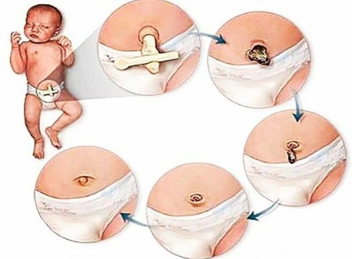 How to heal the baby's navel after birth