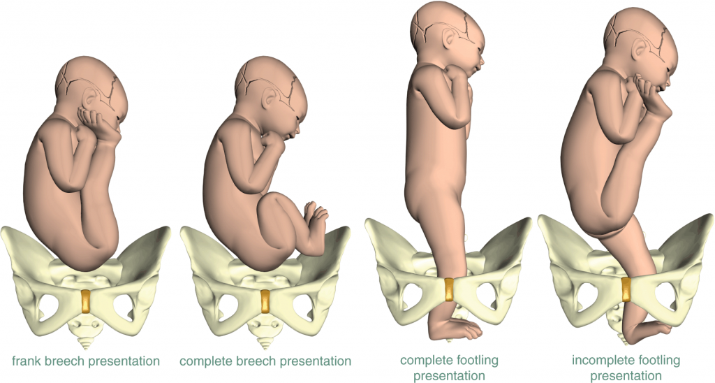 Different types of breech presentation