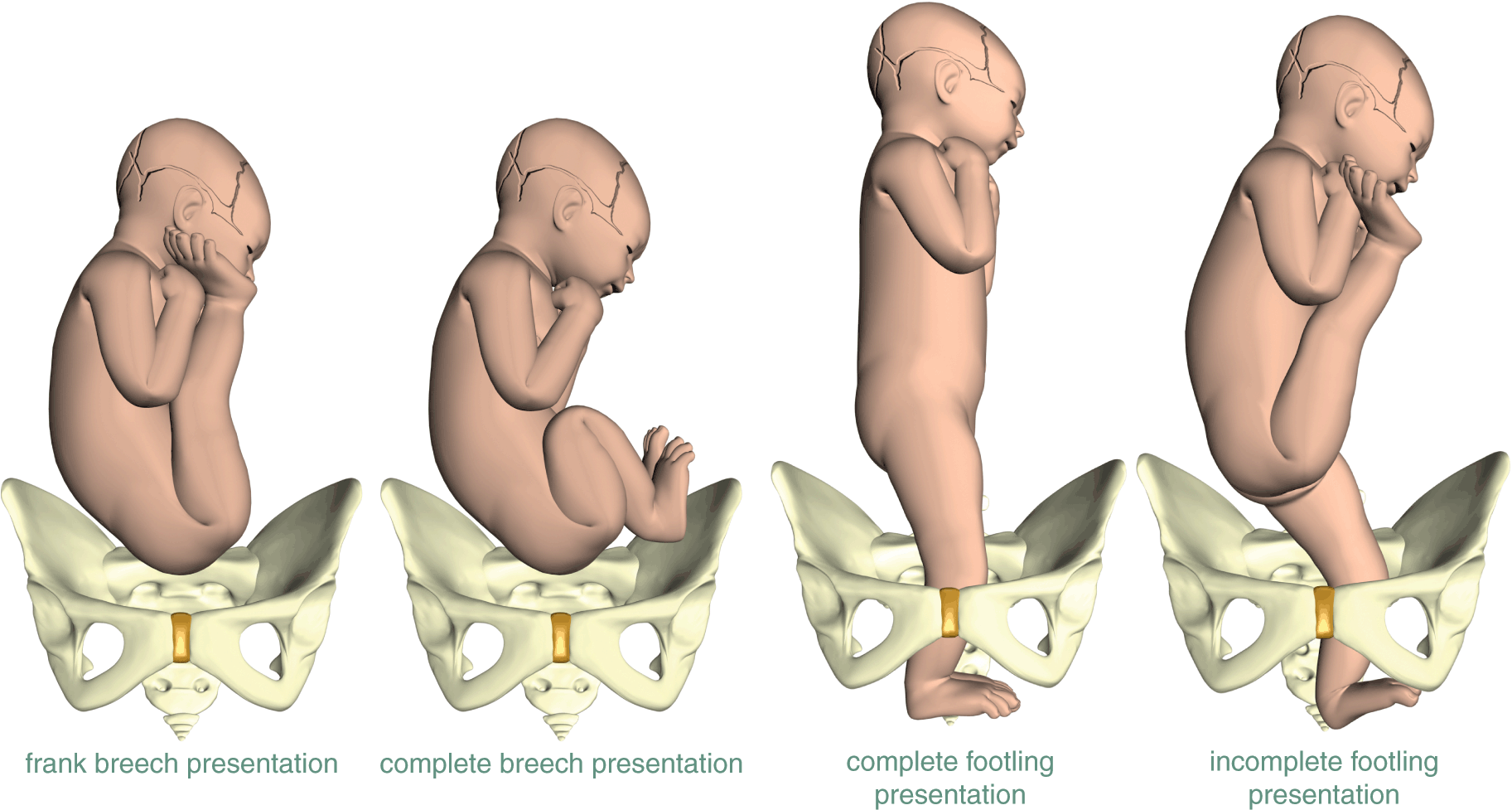 Breech Presentation In Pregnancy: Types, Causes And Signs - SexPally
