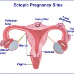 How to know if i'm having ectopic pregnancy