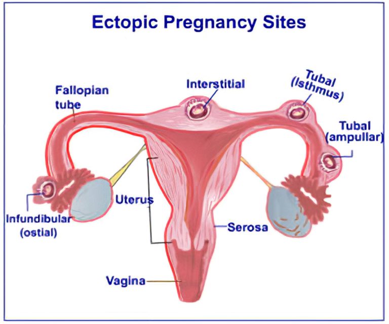 How to know if i'm having ectopic pregnancy