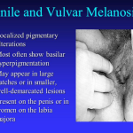 Penile and vulva melanosis vs melanoma