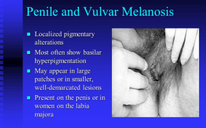 Penile and vulva melanosis vs melanoma