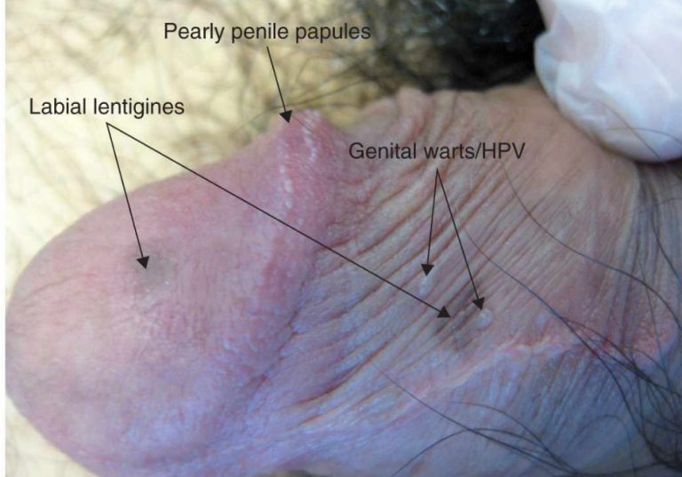 Causes and symptoms of genital melanosis and melanoma