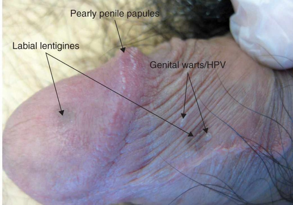 Penile Melanosis vs Melanoma Causes and Symptoms Causes and symptoms of genital melanosis and melanoma